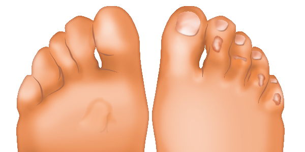 Cors et corne podiatre411