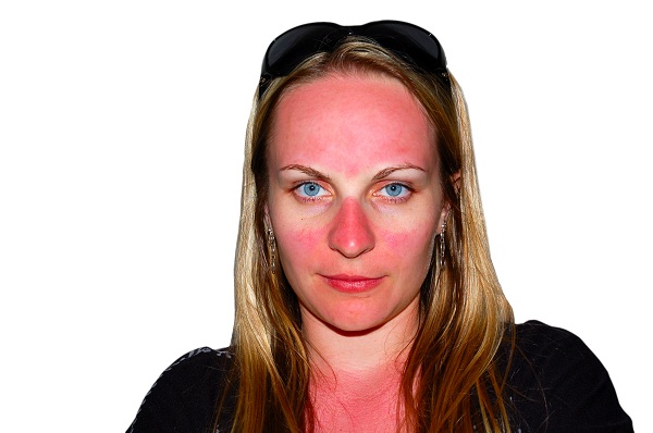 Coup de soleil