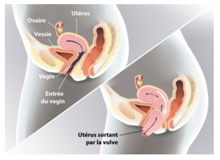 Descente de l uterus