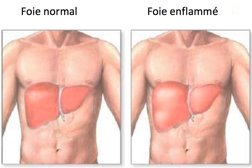 Foie normal foie enflamme