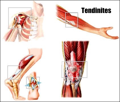 Tendinites et hygroma
