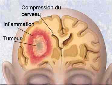 Tumeur cerveau